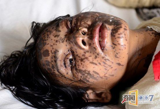 孟加拉国母女被泼硫酸烧伤 伤疤让人触目惊心
