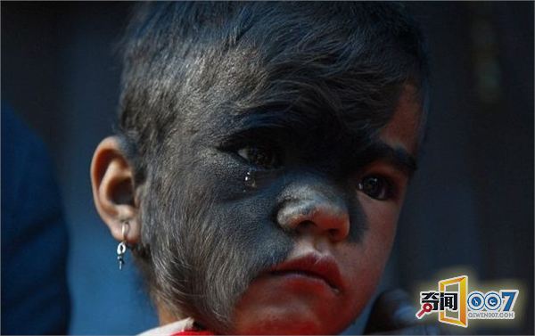 尼泊尔9岁毛孩成功接受手术:曾遭村民排斥