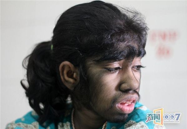 孟女孩患罕见狼人综合症 身上长满浓黑毛发